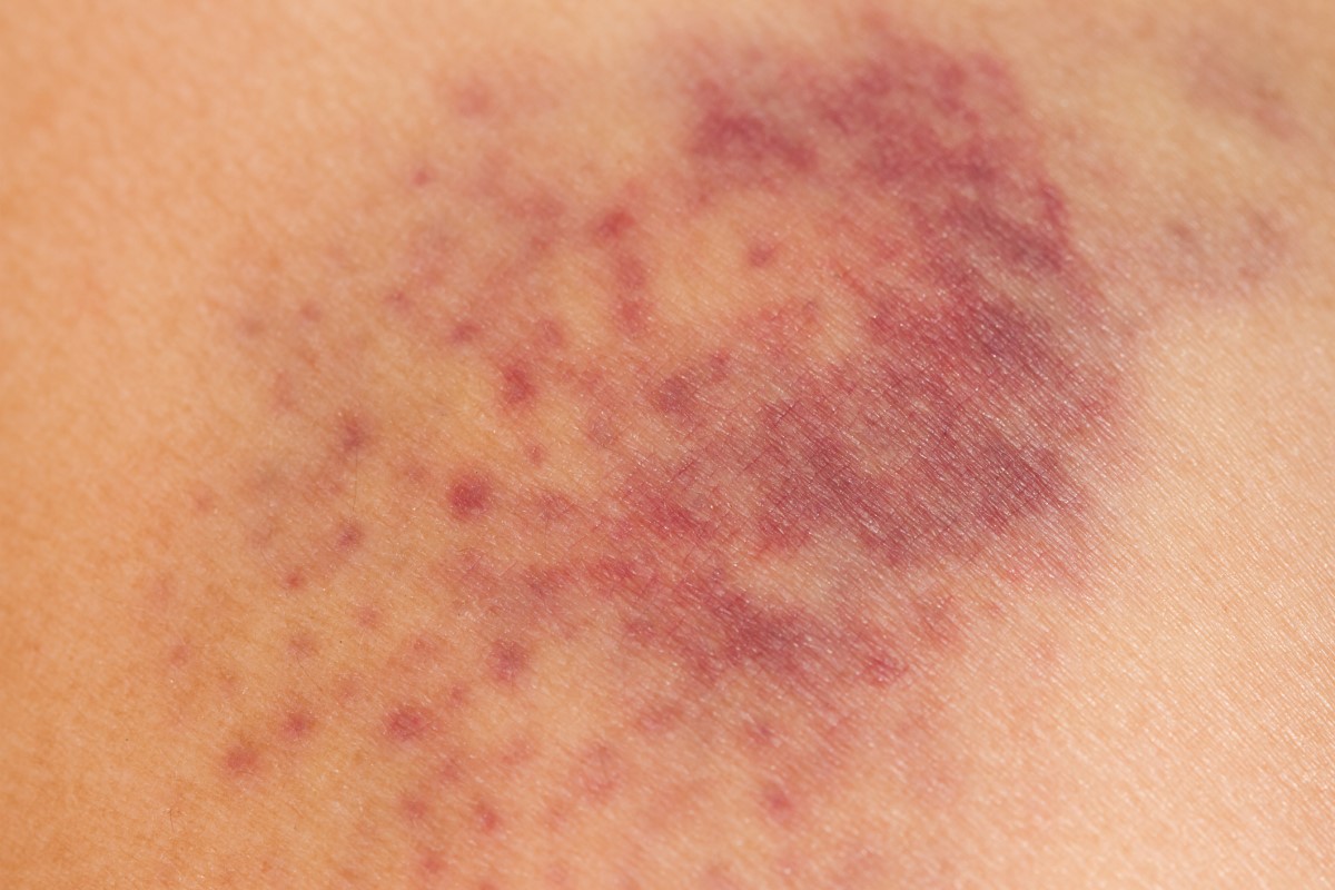 Skin with small blood bruises like a pinhead - a sign of disease or a result of an accident